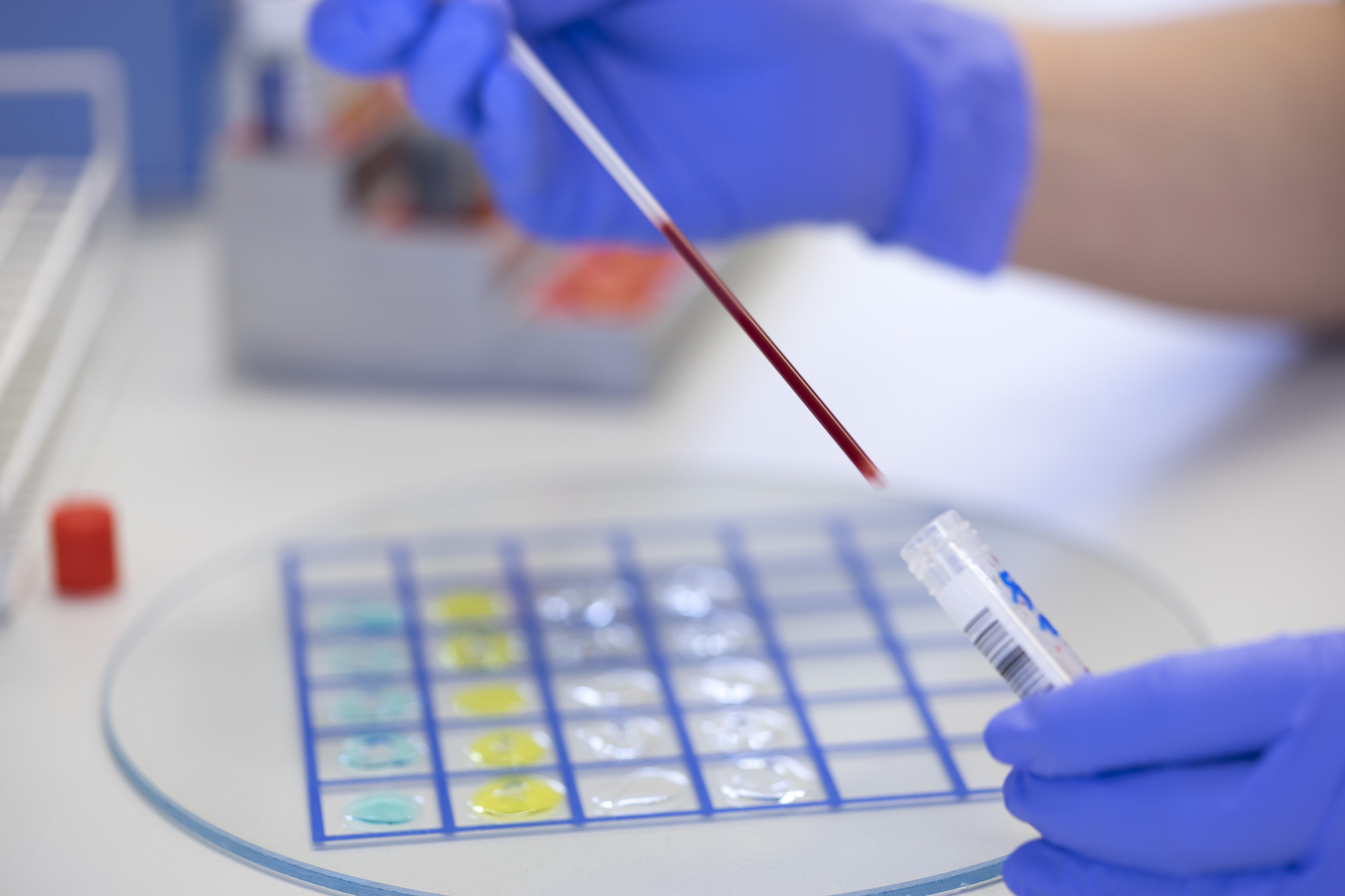 Im Labor wird das bei einer Blutspende abgenommene Blut untersucht. Ein Teil des Blutes wird in einer Pipette gezeigt.