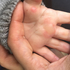 Die Hand eines 1,5 Jahre alter Bub mit Verbrennungen 1. und 2. Grades auf der Handfläche. Verursacht durch das Angreifen einer heißen Oberfläche.